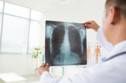MZ przygotowuje program kompleksowego leczenia raka płuc