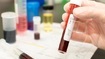 hiv test